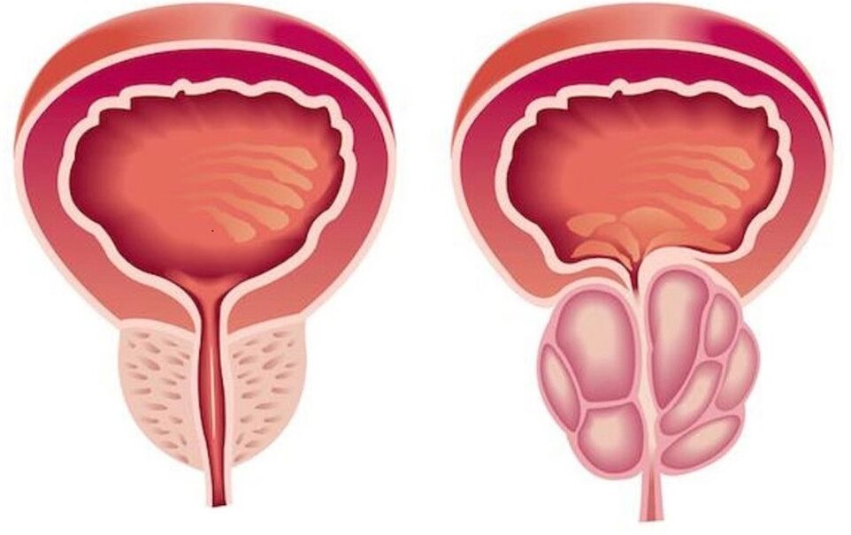 здрава и воспалена простата со простатитис